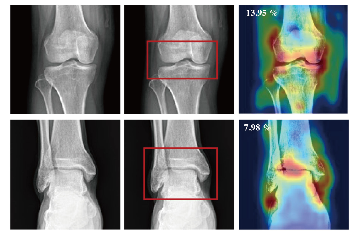Classification Models for Arthropathy Grades of Multiple Joints Based on Hierarchical Continual Learning